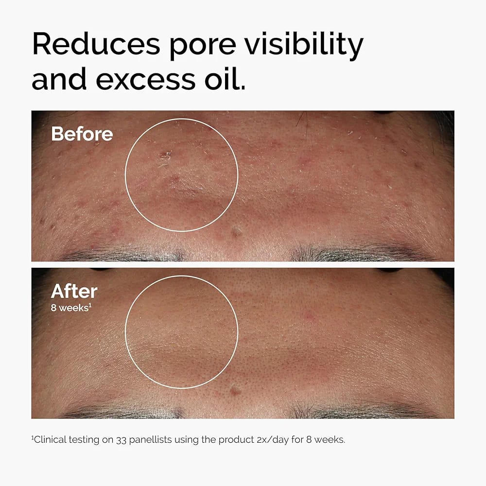 The Ordinary Niacinamide 10% + Zinc 1% Oil Control Serum - 30ml
